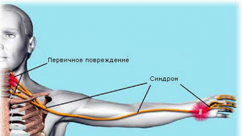 Почему при работе за компьютером болят руки, или синдром лестничной мышцы